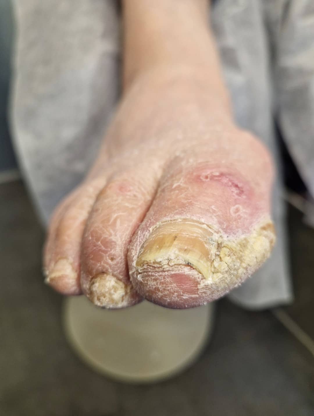 Pedicure podologiczny