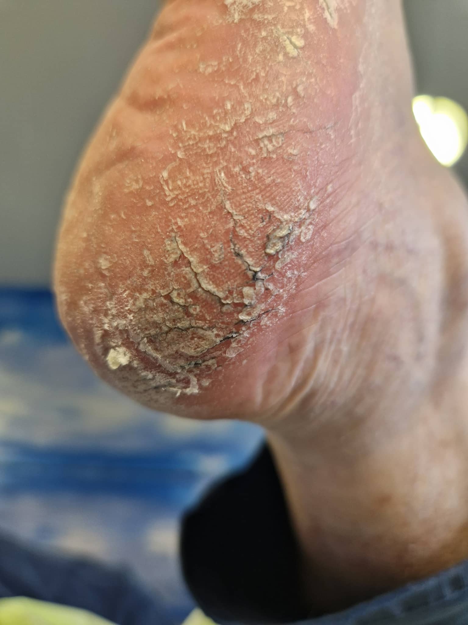 Terapia pękających pięt