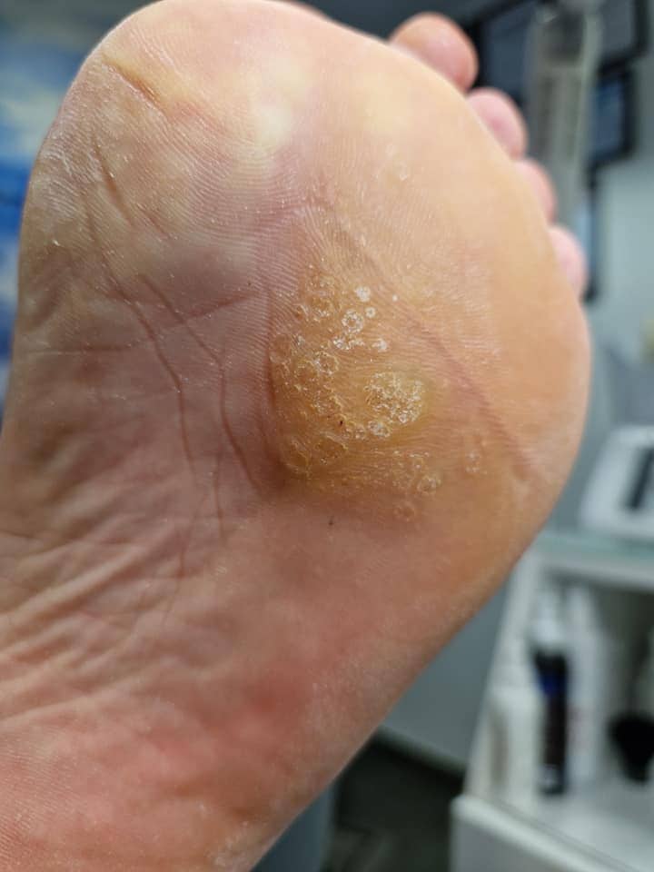 Usuwanie brodawek wirusowych